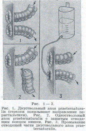 anus praeternaturalis